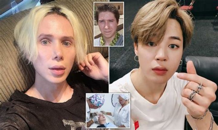 Oli London Before Surgery And Operation